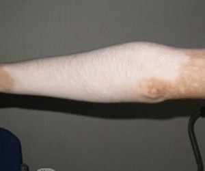 手部为什么会患上白斑病