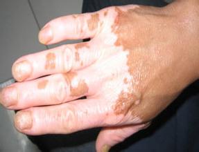 预防手部白癜风常见方法有哪些